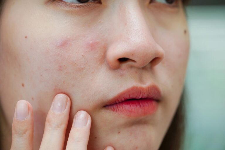 Read more about the article The Causes & Symptoms of Pregnancy Acne; The Safest vs Most Dangerous Acne Remedies