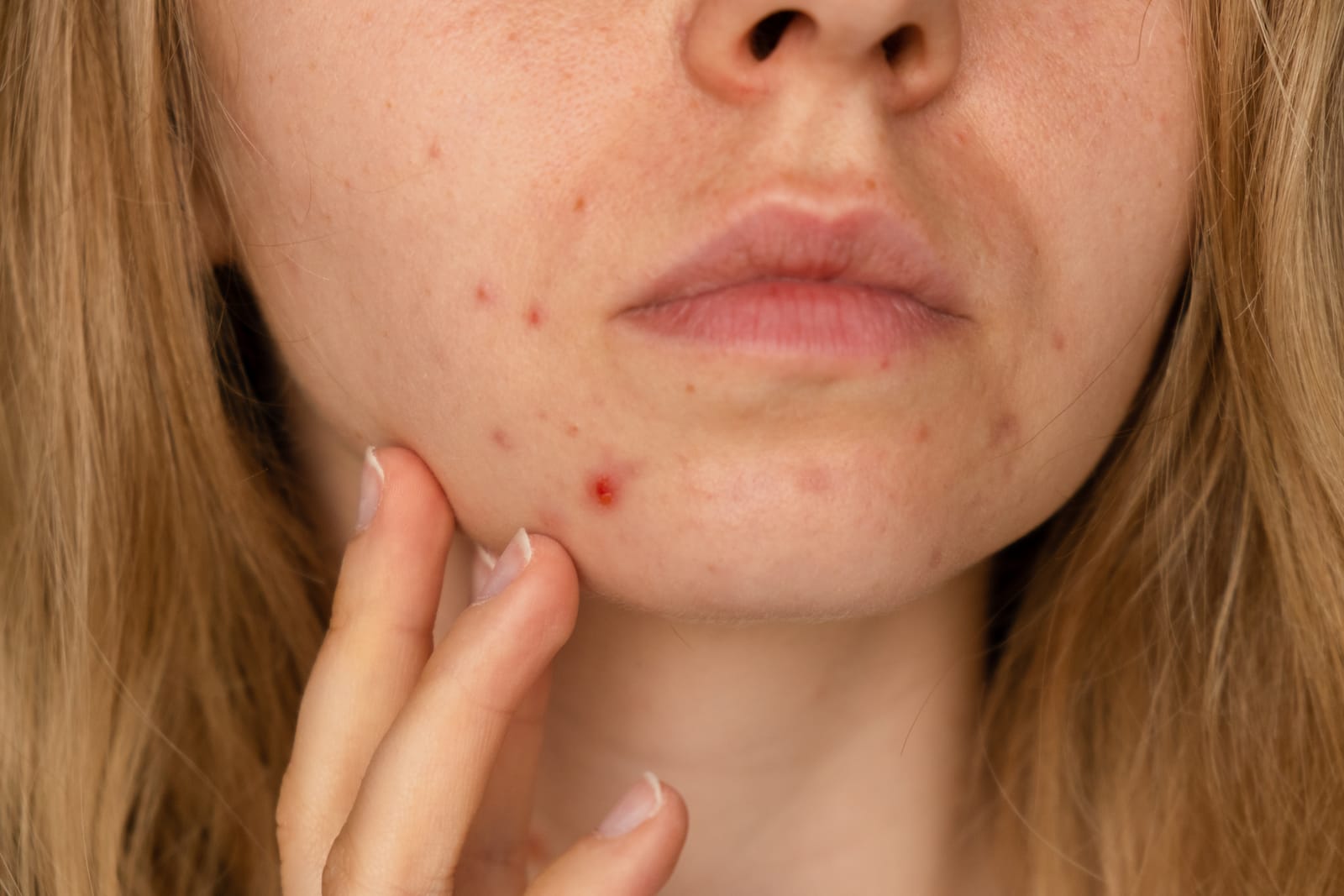 Read more about the article Having Postpartum Acne Breakouts? Effective Home Remedies